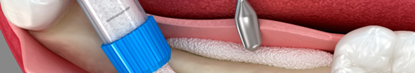 A dental bone graft can help rebuild your jaw to accommodate dental implants